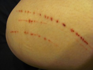 One of the wounds on my leg the day after, and it still looked like I'd walked through a plate-glass door.