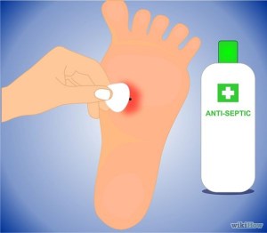 No, I didn't take pictures of my foot, but this is pretty close to where the staple got me. Image from WikiHow.