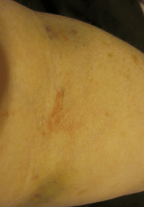 The arm where they drained a good portion of my blood. I think they left me a little.