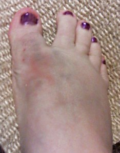 My foot Tuesday night, and the bruising still isn't fully developed ... might match the polish by the time it's done. Yeesh.
